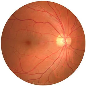 Gesunde Netzhaut – normaler Augenhintergrund