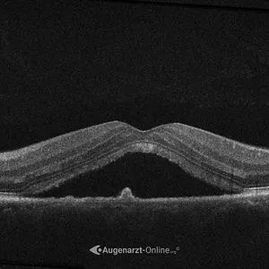 Chorioretinopathia Centralis Serosa (CRCS)