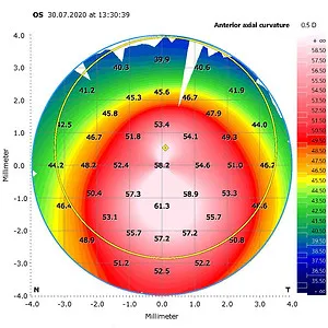 Hornhauttopographie bei Keratokonus