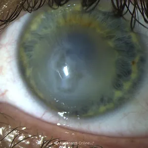 Hydrops bei fortgeschrittenem Keratokonus