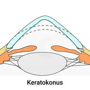 Illustration: Keratokonus – kegelförmige Hornhaut