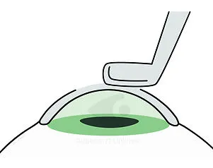 Betäubung mit Augentropfen