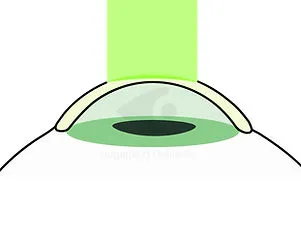 Nachsorge nach dem Crosslinking