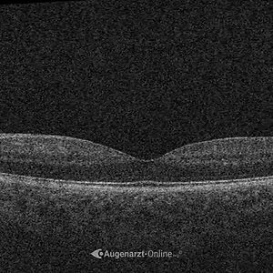 Gesunde Makula im OCT