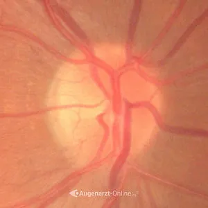 Gesunder Sehnerv – normale Papille