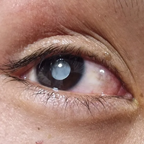 Grauer Star – Medizinische Indikation bei Kind