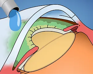 Betäubung mit Augentropfen