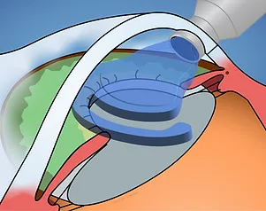 Schritt 3: Kunstlinse einsetzen