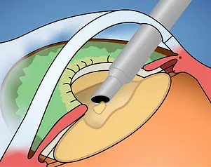 Schritt 2: Getrübte Linse absaugen