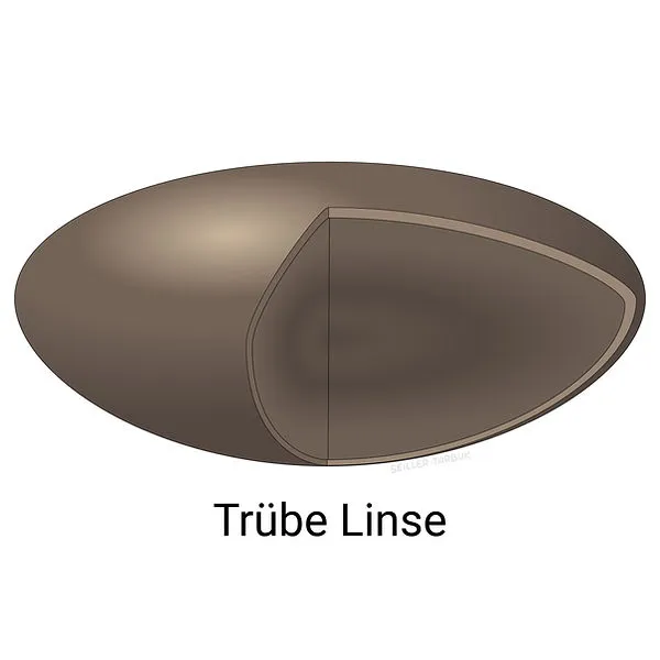 Grauer Star – Trübe Linse