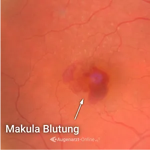 Feuchte Makuladegeneration – Spätstadium