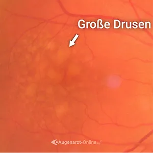 Trockene Makuladegeneration – Frühstadium