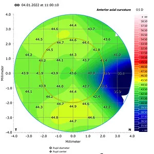 Pterygium – Astigmatismus in der Topographie