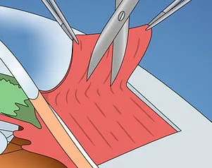 Abtragung des Flügelfells