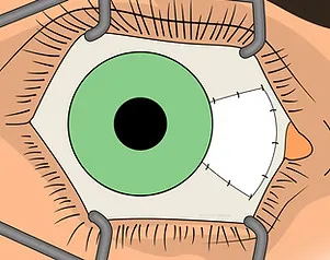 Transplantat zur Deckung der Wundstelle