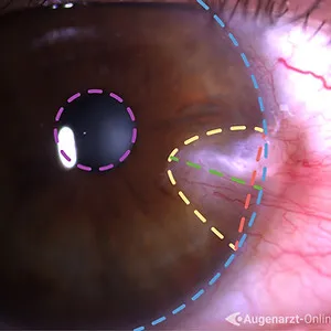 Pterygium-Spezialist in Wien
