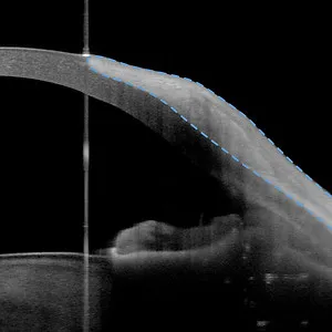 Pterygium – Anterion Vorderabschnitt-OCT