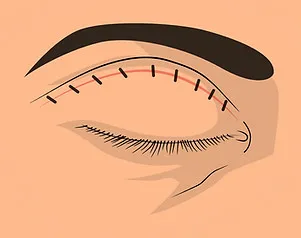 Lidstraffung – Nachsorge mit Druckverband