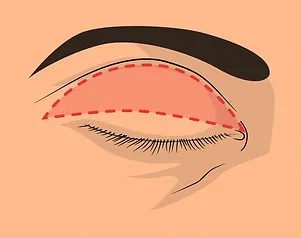 Planung der Lidstraffung – Markierung der Lider