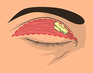 Lidstraffung – Operation