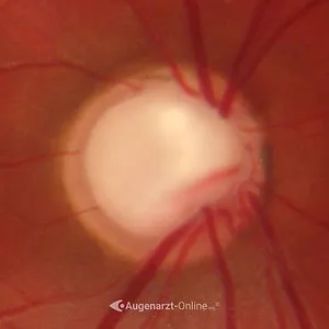 Sehnervschaden durch Glaukom