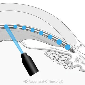 SLT Laser – Selektive Lasertrabekuloplastik Übersicht