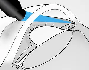 SLT Laser Durchführung