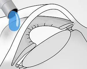 SLT Laser Vorbereitung – Betäubung