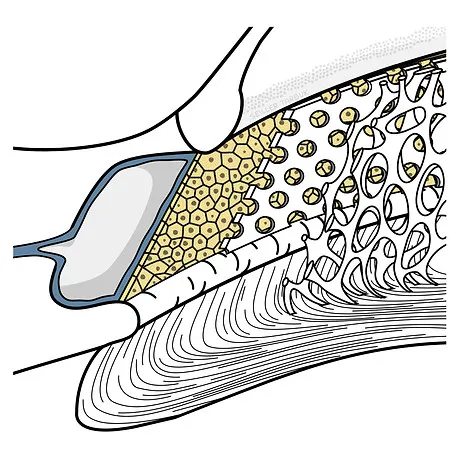 Kammerwinkel vor SLT Laser