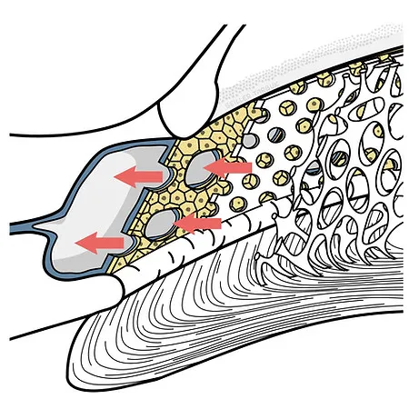 Kammerwinkel nach SLT Laser