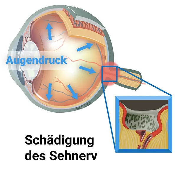 Glaukom – Ist ein SLT Laser sinnvoll?