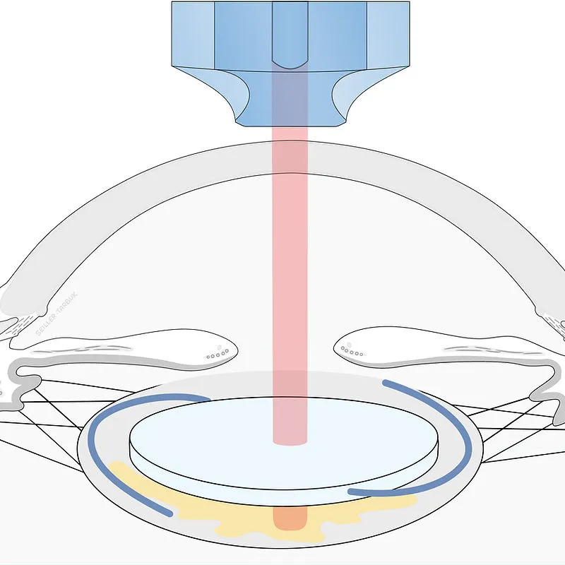 Nachsorge nach YAG Laser in Wien