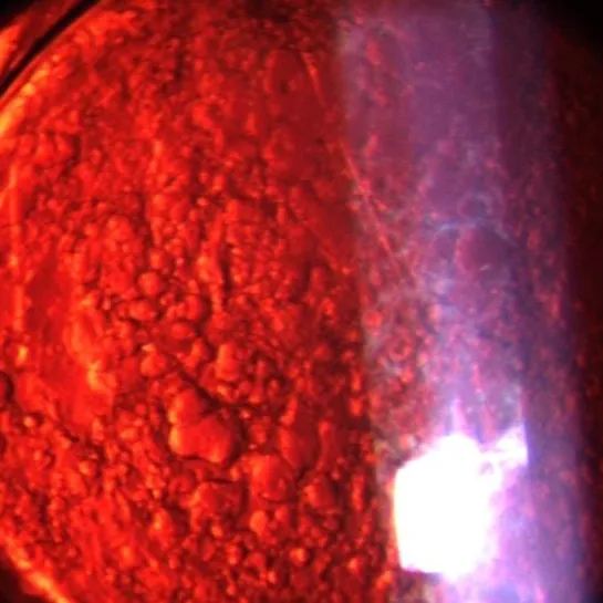 Nachstar – sekundäre Katarakt