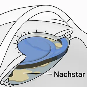 Nachstar (sekundäre Katarakt) – Illustration