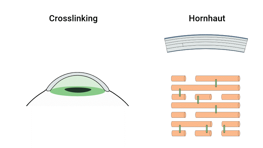 Animation: Crosslinking – Vernetzung der Hornhautfasern