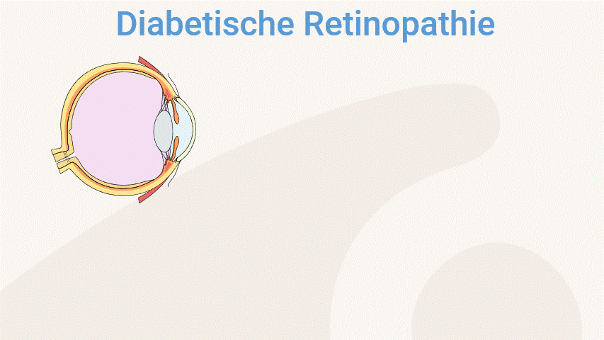 Diabetische Retinopathie – Erklärung Animation