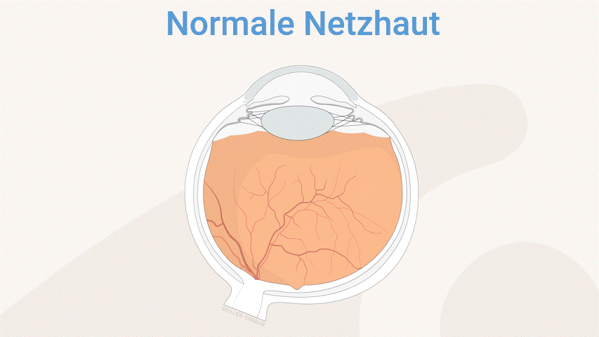 Chorioretinopathia Centralis Serosa – Erklärung Animation