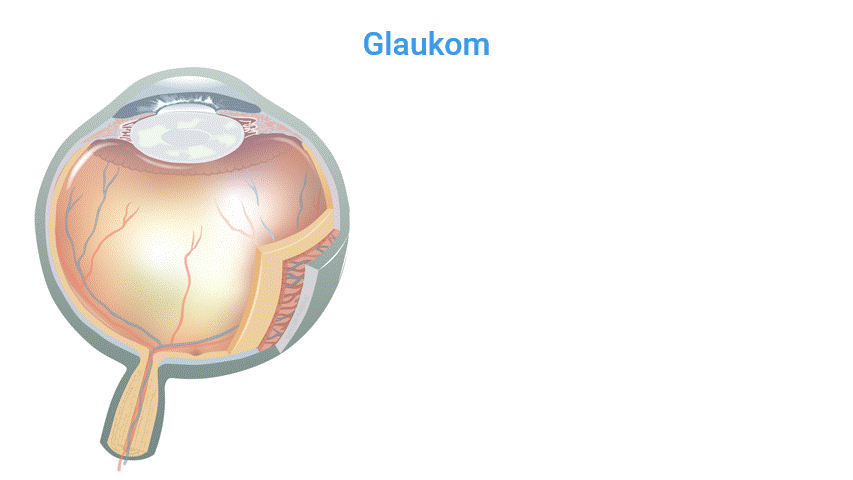 Grüner Star – Erklärung Animation