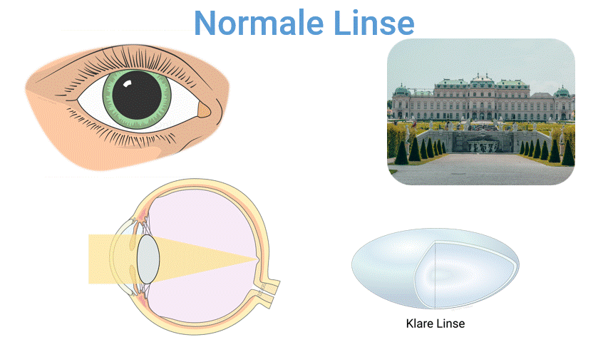 Grauer Star – Erklärung Animation